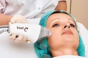 lasersko frakcijsko pomlađivanje kože lica