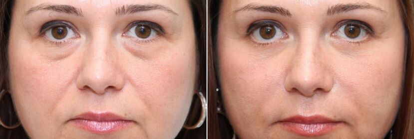 Prije i poslije blefaroplastike - uklanjanja masnog tijela ispod očiju i zatezanja kože