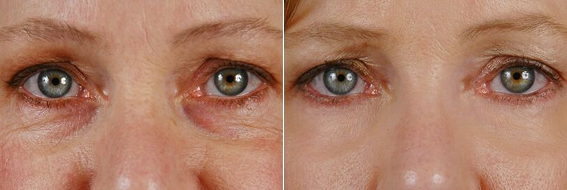 Prije i poslije laserske operacije - pomlađivanje kože oko očiju