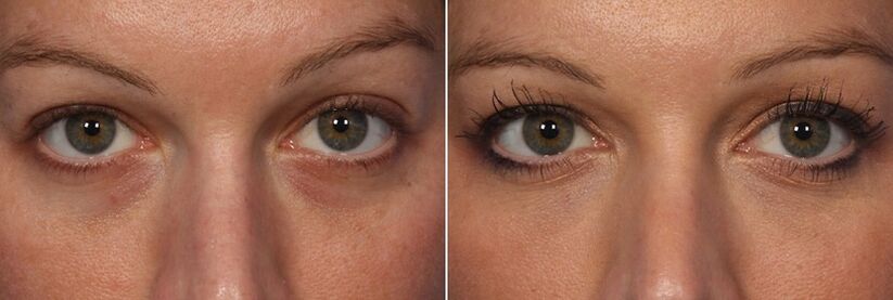 Prije i poslije uporabe injektibilnih filera - smanjenje krugova ispod očiju